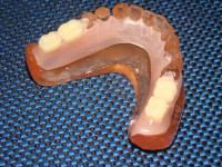 Prótese Dentária Bilateral